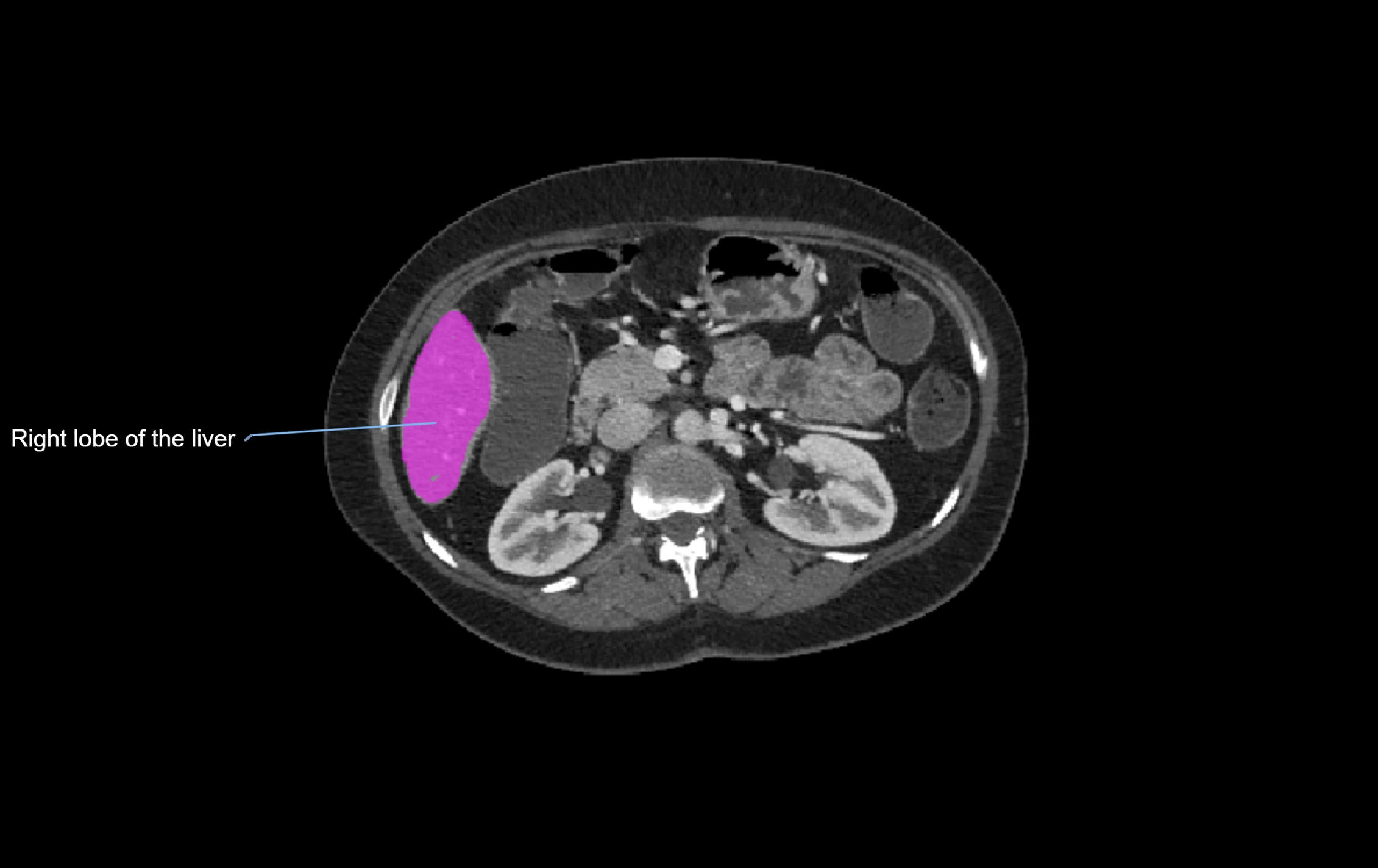 CT lliver lobes axial cross sectional anatomy labelled image -00023.webp